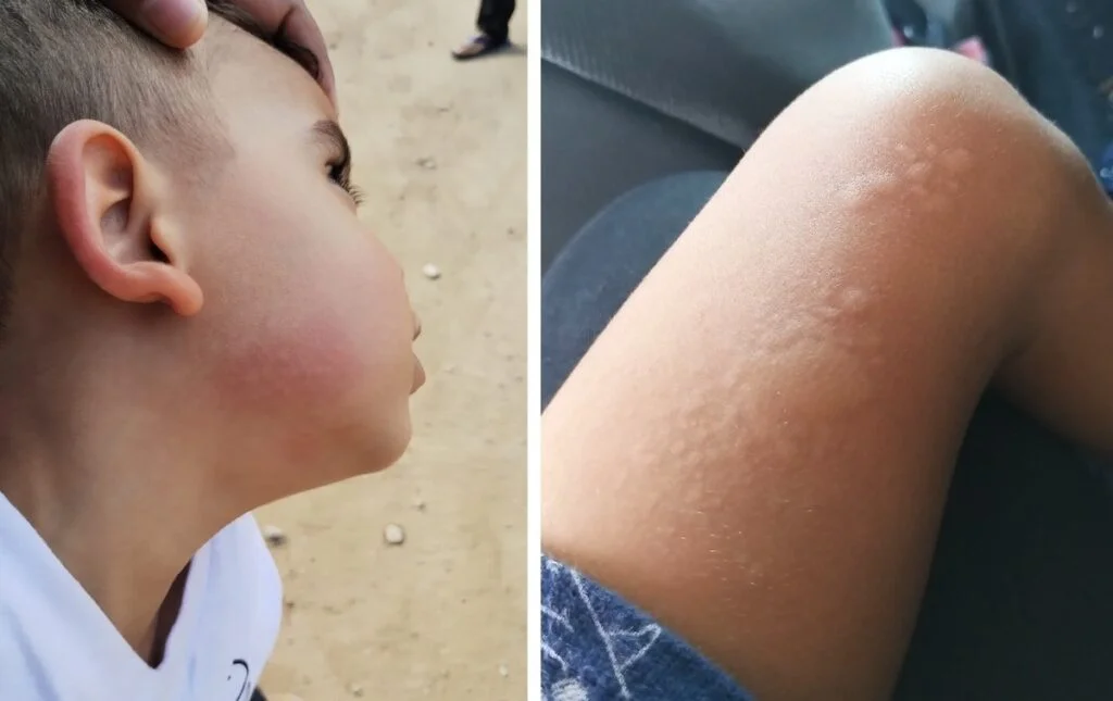 Alergia à Proteína do Leite de Vaca: especialista fala sobre a doença, sintomas e como tratar | Sorocaba e Jundiaí